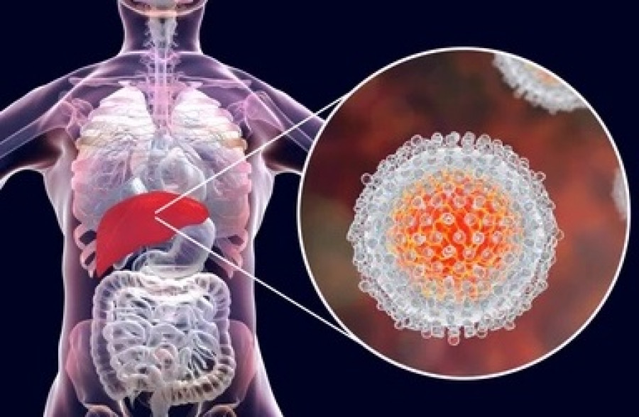 Ilustrasi Hepatitis Akut. (Foto: Shutterstock)